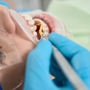 Tips on Caring for Your Fillings
