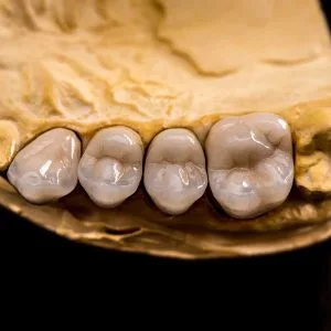 Looking for Dental Crowns in Bentleigh? Here’s Your Expert Local Guide